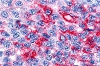 IHC-P analysis of human skin, melanoma tissue using GTX13113 ROR beta antibody. Antigen retrieval : Heat-induced antigen retrieval