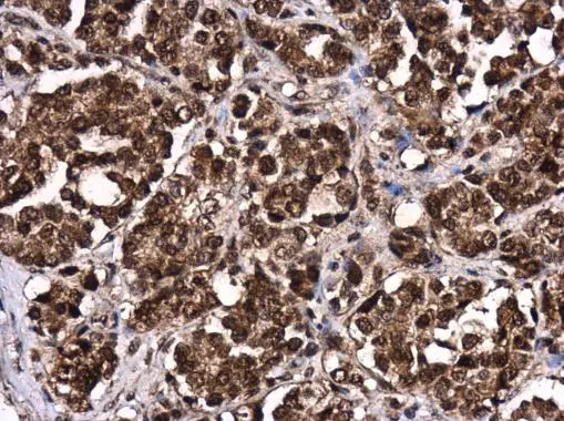 LIN28B antibody detects LIN28B protein at cytoplasm and nucleus in human colon by immunohistochemical analysis. Sample: Paraffin-embedded human colon. LIN28B antibody (GTX131546) diluted at 1:500. 
 Antigen Retrieval: Citrate buffer, pH 6.0, 15 min