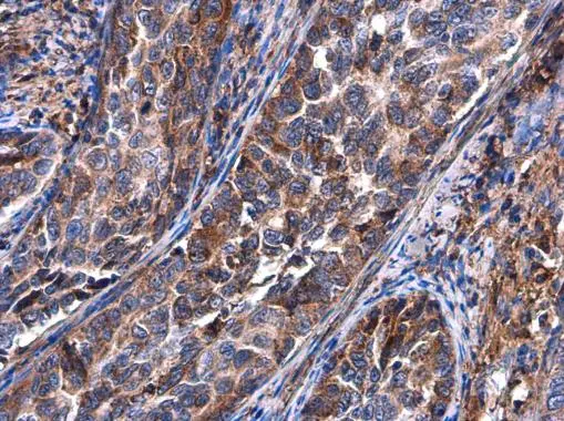 BASP1 antibody detects BASP1 protein at cytoplasm in human cervical carcinoma by immunohistochemical analysis. Sample: Paraffin-embedded human cervical carcinoma. BASP1 antibody (GTX131728) diluted at 1:500. 
 Antigen Retrieval: Citrate buffer, pH 6.0, 15 min