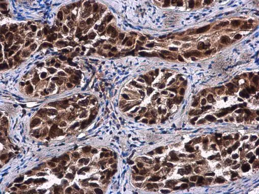 Rif1 antibody detects Rif1 protein at cytoplasm and nucleus in human cervical carcinoma by immunohistochemical analysis. Sample: Paraffin-embedded human cervical carcinoma. Rif1 antibody (GTX131889) diluted at 1:500. 
 Antigen Retrieval: Citrate buffer, pH 6.0, 15 min