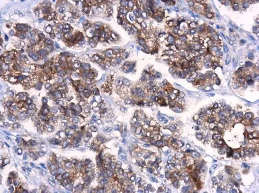 ATG10 antibody detects ATG10 protein at cytoplasm in human ovarian cancer by immunohistochemical analysis. Sample: Paraffin-embedded human ovarian cancer. ATG10 antibody (GTX132449) diluted at 1:500. 
 Antigen Retrieval: Citrate buffer, pH 6.0, 15 min