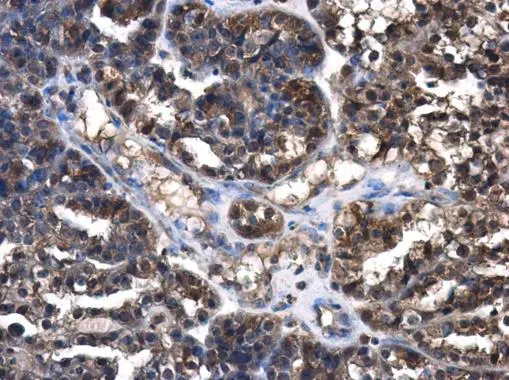 Cystatin C antibody detects Cystatin C protein at cytoplasm in human ovary by immunohistochemical analysis. Sample: Paraffin-embedded human ovary. Cystatin C antibody (GTX132567) diluted at 1:400.
Antigen Retrieval: Citrate buffer, pH 6.0, 15 min Cystatin C antibody detects Cystatin C protein at cytoplasm in human ovary by immunohistochemical analysis. Sample: Paraffin-embedded human ovary. Cystatin C antibody (GTX132567) diluted at 1:400.
Antigen Retrieval: Citrate buffer, pH 6.0, 15 min
