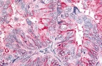IHC-P analysis of human ovary, carcinoma tissue using GTX13306 BAI2 antibody. <br>Antigen retrieval : Heat-induced antigen retrieval
