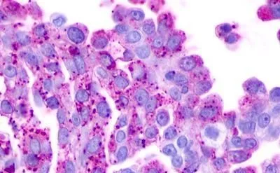 IHC-P analysis of ovary, carcinoma tissue using GTX13319 EBI2 antibody.
