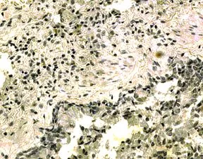 IHC analysis of human lung tissue using GTX13321 IL21 Receptor antibody. IHC analysis of human lung tissue using GTX13321 IL21 Receptor antibody.