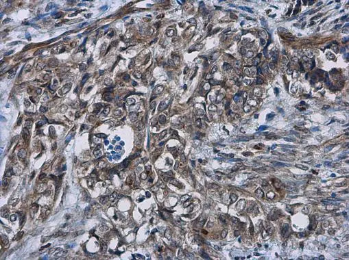 Cyclin D2 antibody detects Cyclin D2 protein at cytoplasm in human cervical carcinoma by immunohistochemical analysis. Sample: Paraffin-embedded human cervical carcinoma. Cyclin D2 antibody (GTX133418) diluted at 1:500.
Antigen Retrieval: Citrate buffer, pH 6.0, 15 min