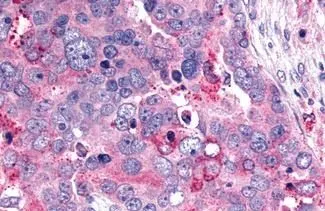 IHC-P analysis of human ovary, carcinoma tissue using GTX13343 GHRHR antibody. <br>Antigen retrieval : Heat-induced antigen retrieval