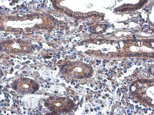 PLCB2 antibody detects PLCB2 protein at cytoplasm by immunohistochemical analysis. Sample: Paraffin-embedded human colon cancer. PLCB2 stained by PLCB2 antibody (GTX133765) diluted at 1:500.
Antigen Retrieval: Citrate buffer, pH 6.0, 15 min PLCB2 antibody detects PLCB2 protein at cytoplasm by immunohistochemical analysis. Sample: Paraffin-embedded human colon cancer. PLCB2 stained by PLCB2 antibody (GTX133765) diluted at 1:500.
Antigen Retrieval: Citrate buffer, pH 6.0, 15 min