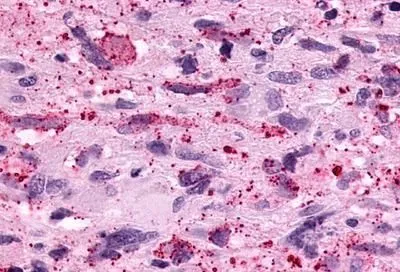 IHC-P analysis of human brain, glioblastoma tissue using GTX13381 PTGER3 antibody. Antigen retrieval : Heat-induced antigen retrieval IHC-P analysis of human brain, glioblastoma tissue using GTX13381 PTGER3 antibody. Antigen retrieval : Heat-induced antigen retrieval