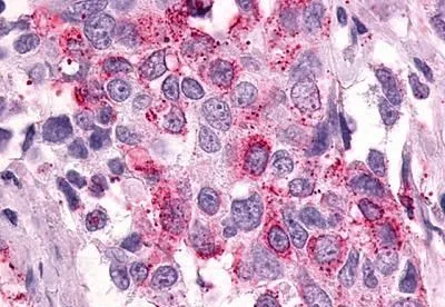IHC-P analysis of human breast, carcinoma tissue using GTX13381 PTGER3 antibody. Antigen retrieval : Heat-induced antigen retrieval
