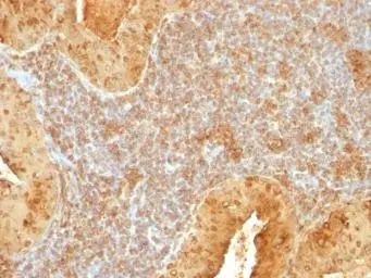 IHC-P analysis of human salivary tumor tissue using GTX13575 Cytochrome C antibody [7H8.2C12].