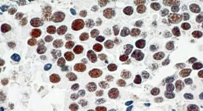 IHC-P analysis of human urinary bladder carcinoma tissue using GTX13579 TRF2 antibody [4A794.15]. Dilution : 4 microg/ml Antigen retrieval : 10 mM sodium citrate buffer, pH 6.0