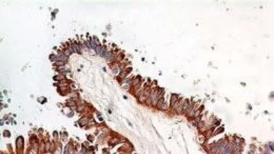 IHC-P analysis of human ovarian cystadenocarcinoma tissue using GTX13594 NFkB p65 antibody [112A1021]. Dilution : 5 microg/ml