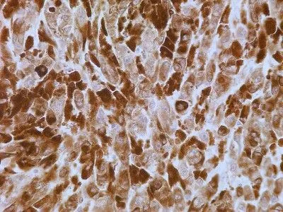 IHC-P analysis of human lymph node cancer tissue using GTX13680 Psoriasin antibody [47C1068]. Dilution : 5 ug/ml