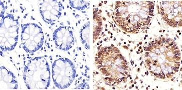 IHC-P analysis of human colon tissue using GTX14210 PLK1 antibody [Mixed clones]. Right : Primary antibody Left : Negative control without primary antibody Antigen retireval : 10mM sodium citrate (pH 6.0), microwaved for 8-15 min Dilution : 1:20