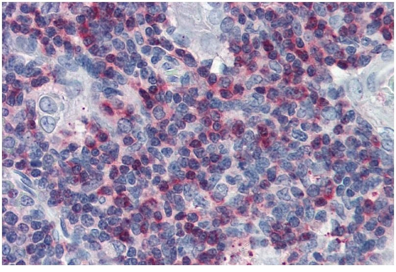 IHC-P analysis of human thymus tissue using GTX14942 SLP76 antibody. IHC-P analysis of human thymus tissue using GTX14942 SLP76 antibody.