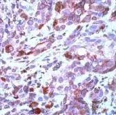 Human melanoma stained with GTX15175