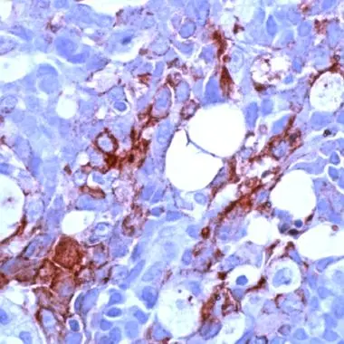 Human Breast Carcinoma stained with anti-MUC-1/EMA/Epithelial Membrane Antigen antibody (GTX15481) Human Breast Carcinoma stained with anti-MUC-1/EMA/Epithelial Membrane Antigen antibody (GTX15481)