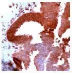 GTX15501 staining PDGF Receptor alpha in human ovarian carcinoma by Immunohistochemistry (FFPE-sections).
