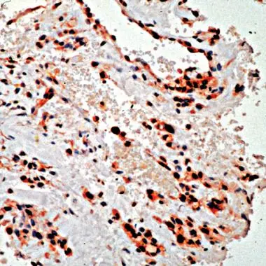 Human Ovarian Carcinoma stained with anti-PDGFR alpha antibody (GTX15501) Human Ovarian Carcinoma stained with anti-PDGFR alpha antibody (GTX15501)