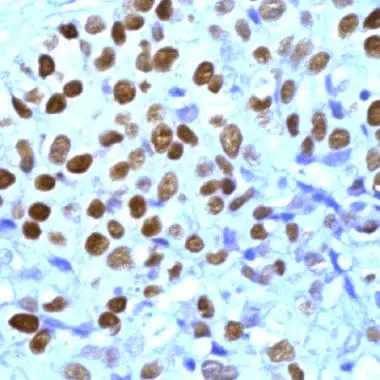 Human Breast Carcinoma stained with anti-Progesterone Receptor (PR) antibody (GTX15509) Human Breast Carcinoma stained with anti-Progesterone Receptor (PR) antibody (GTX15509)