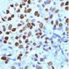 GTX15510 staining Progesterone Receptor in breast carcinoma by Immunohistochemistry (FFPE-sections).