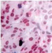 GTX15518 staining Retinoid X Receptor gamma in breast carcinoma by Immunohistochemistry (FFPE-sections).