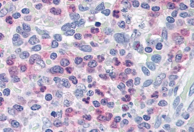 IHC-P analysis of human spleen using GTX15723 Munc 13-4 antibody, C-term. Antigen retrieval : citrate buffer pH 6 Dilution : 5microg/ml IHC-P analysis of human spleen using GTX15723 Munc 13-4 antibody, C-term. Antigen retrieval : citrate buffer pH 6 Dilution : 5microg/ml