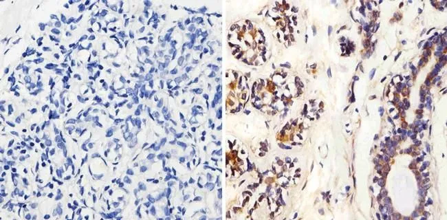 IHC-P analysis of human breast tissue using GTX15773 MMP2 antibody [MMP2/2C1-1D12]. Right : Primary antibody Left : Negative control without primary antibody Antigen retrieval : 10mM sodium citrate (pH 6.0),microwaved for 8-15 min Dilution : 1:20