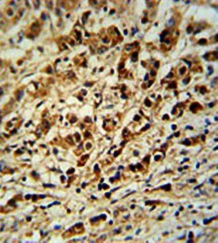 IHC-P analysis of human breast carcinoma tissue using GTX16209 AVL9 antibody. IHC-P analysis of human breast carcinoma tissue using GTX16209 AVL9 antibody.