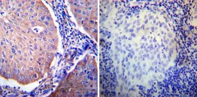 IHC-P analysis of human cervical carcinoma tissue using GTX16318 Glucocorticoid Receptor alpha antibody. Left : Primary antibody Right : Negative control without primary antibody Antigen retrieval : heat induced antigen retrieval was performed using 10mM sodium citrate (pH6.0) buffer, microwaved for 8-15 minutes Dilution : 1:20 IHC-P analysis of human cervical carcinoma tissue using GTX16318 Glucocorticoid Receptor alpha antibody. Left : Primary antibody Right : Negative control without primary antibody Antigen retrieval : heat induced antigen retrieval was performed using 10mM sodium citrate (pH6.0) buffer, microwaved for 8-15 minutes Dilution : 1:20