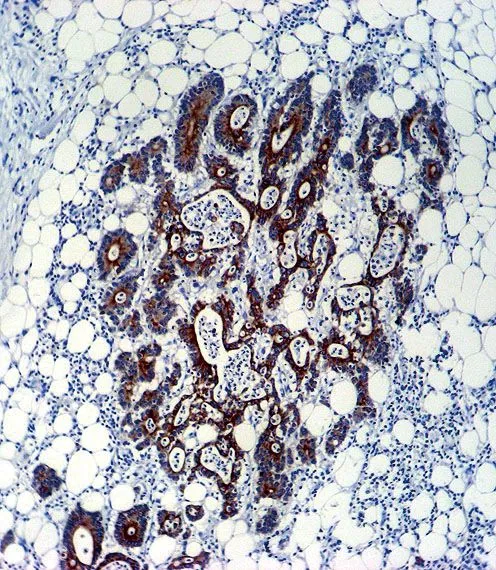 IHC-P analysis of human colon carcinoma using GTX16335 TGF beta 2 antibody [220ct16.4.3.1].