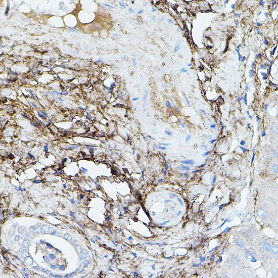 IHC-P analysis of human liver cancer tissue using GTX16415 TGFBI antibody. Dilution : 1:100