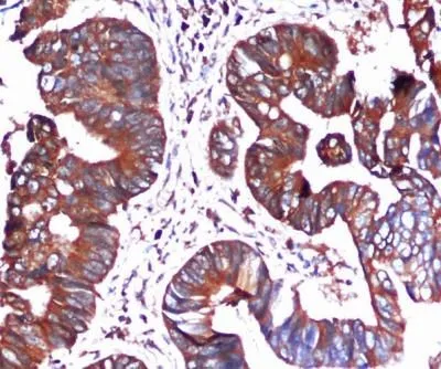 IHC-P analysis of colorectal cancer using Grp78 antibody [9E4-2A7-H6] at a dilution of 1:100. Antigen retrieval was performed by pressure cooking in citrate buffer (pH 6.0).