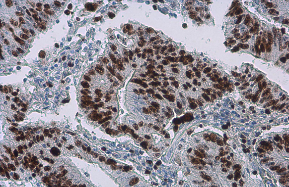 Ki67 antibody [SP6] detects Ki67 protein at nucleus by immunohistochemical analysis. Sample: Paraffin-embedded human colon cancer. Ki67 stained by Ki67 antibody [SP6] (GTX16667) diluted at 1:200. Antigen Retrieval: Citrate buffer,pH 6.0,15 min