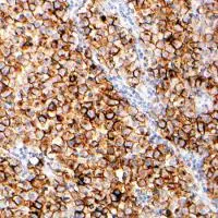 Human Seminoma stained with anti-PLAP antibody Human Seminoma stained with anti-PLAP antibody