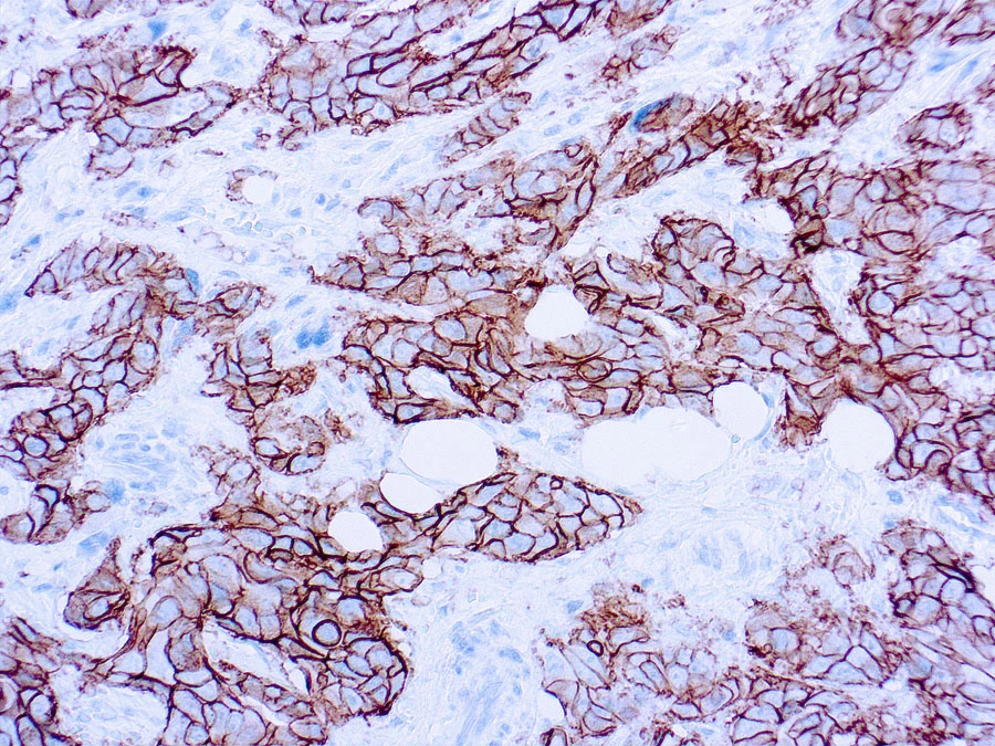 Formalin fixed paraffin embedded human breast carcinoma stained with c-erbB-2 antibody (GTX16932).