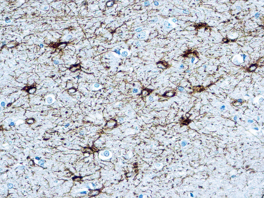 IHC-P analysis of human brain tissue using GTX16997 GFAP antibody. IHC-P analysis of human brain tissue using GTX16997 GFAP antibody.