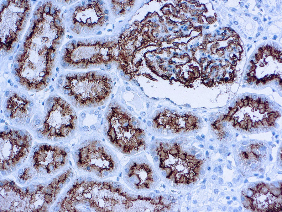 IHC-P analysis of human renal cell carcinoma tissue using GTX17135 CD10 antibody [56C6] (ready-to-use).