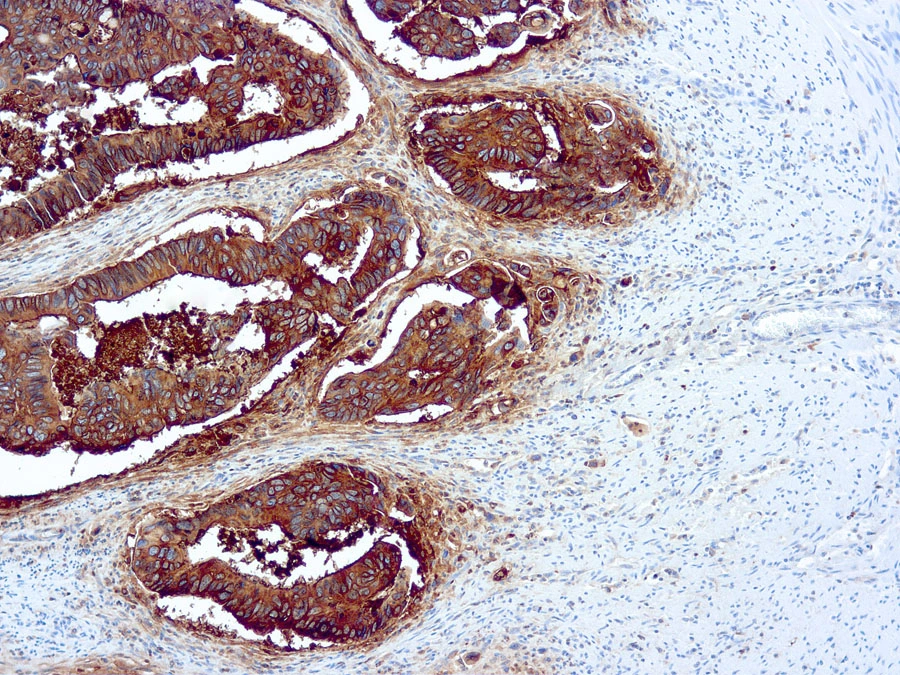 Formalin fixed paraffin embedded human colon carcinoma stained with CEA antibody (GTX17254).
