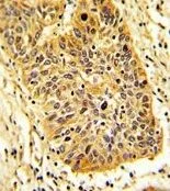 IHC-P analysis of human lung carcinoma using GTX17382 RIOK1 antibody.