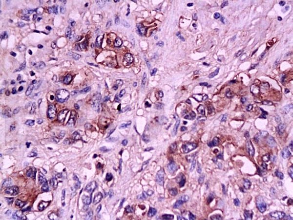 IHC-P analysis of human gastric carcinoma tissue using GTX17548 CD62E antibody. Dilution : 1:200