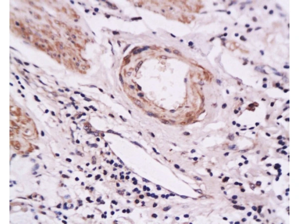 IHC-P analysis of human gastric carcinoma tissue using GTX17548 CD62E antibody. Dilution : 1:200 IHC-P analysis of human gastric carcinoma tissue using GTX17548 CD62E antibody. Dilution : 1:200