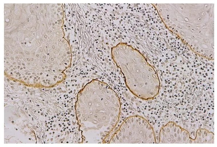 IHC-P analysis of skin cancer tissue using GTX17685 Laminin alpha 3A antibody [BG5].