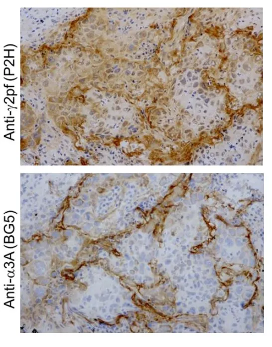 IHC-P analysis of lung cancer (SCC) tissue using GTX17685 Laminin alpha 3A antibody [BG5] and GTX17686 Laminin gamma 2 chain (N-terminal region) antibody [P2H]. The GTX17685 detected basement membrane (BM)-like structure surrounding tumor cells. GTX17686 detected not only BMs but also the cytoplasm of cancer cells. Upper panel : GTX17686 Lower panel : GTX17685