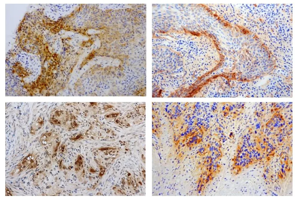 IHC-P analysis of invasive lung cancer (SCC and ADC) tissue using GTX17686 Laminin gamma 2 chain (N-terminal region) antibody [P2H]. The GTX17686 strongly detected cytoplasm of cancer cells at invasion fronts. Upper panel : SCC Lower panel : ADC