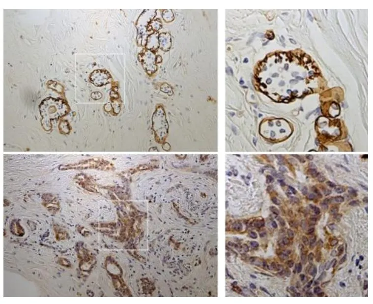IHC-P analysis of normal mammary gland and breast cancer using GTX17686 Laminin gamma 2 chain (N-terminal region) antibody [P2H]. The GTX17686 stains basement membranes surrounding mammary glands in normal tissue, whereas in a breast cancer tissue cytoplasmic accumulation of gamma 2pf or its fragments is detected with P2H. Upper panel : Normal mammary gland Lower panel : Breast cancer