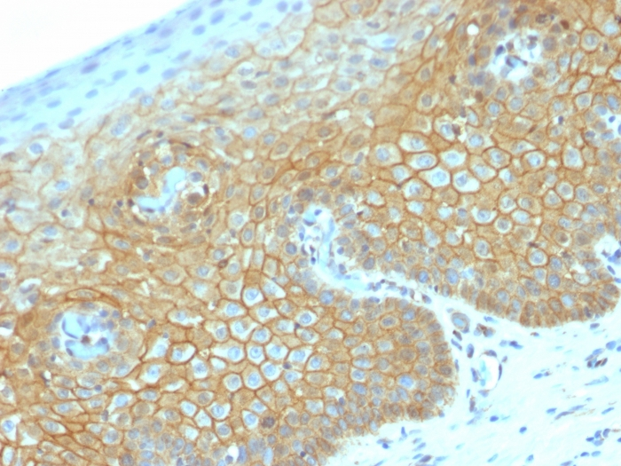 IHC-P analysis of human cervical carcinoma tissue using GTX17706 beta Catenin antibody [CTNNB1/2030R].