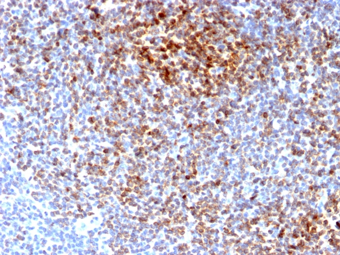 IHC-P analysis of human follicular lymphoma tissue using GTX17713 Bcl-2 antibody [BCL2/2210R].