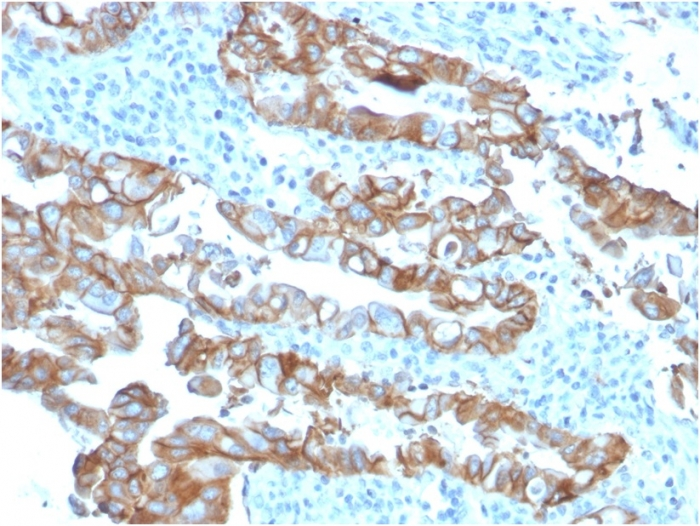 IHC-P analysis of human colon carcinoma tissue using GTX17726 TACSTD2 antibody [TACSTD2/2153].